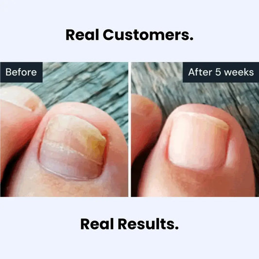 ™ Antifungal Pen